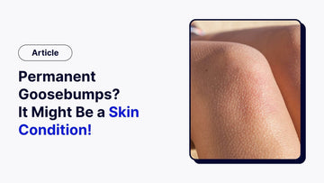 Permanent Goosebumps? It Might Be a Skin Condition