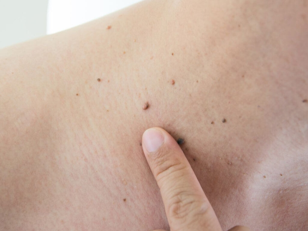 Skin Conditions