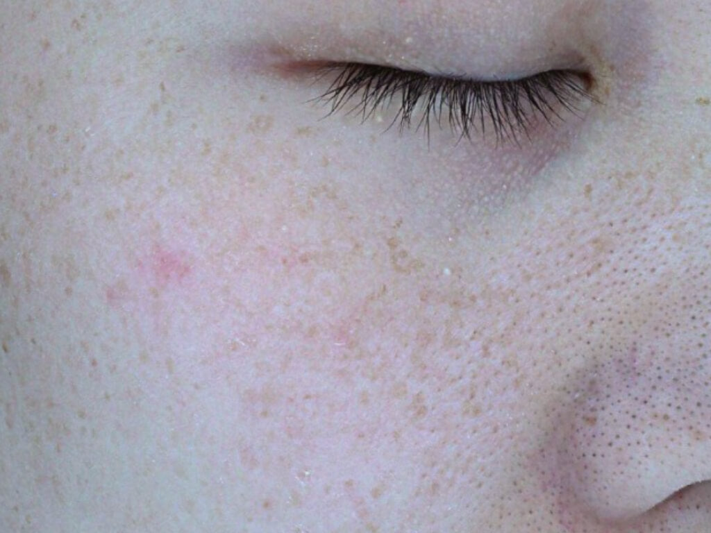 image comparison after