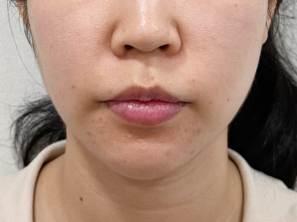 image comparison after