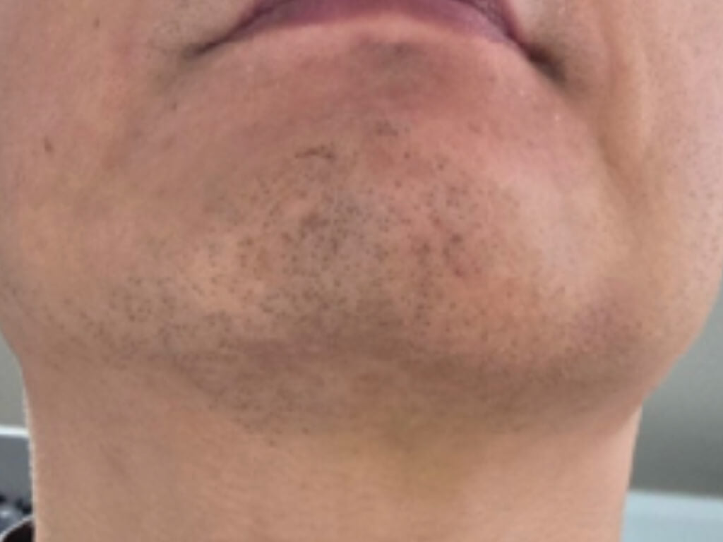image comparison after
