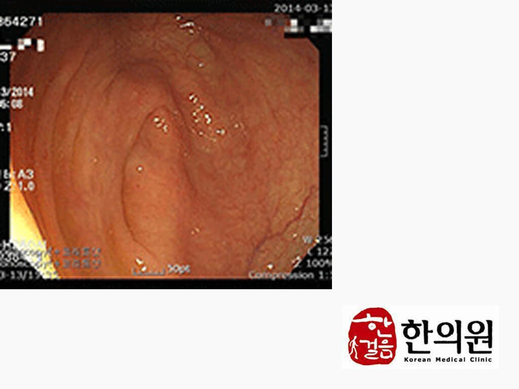 image comparison after