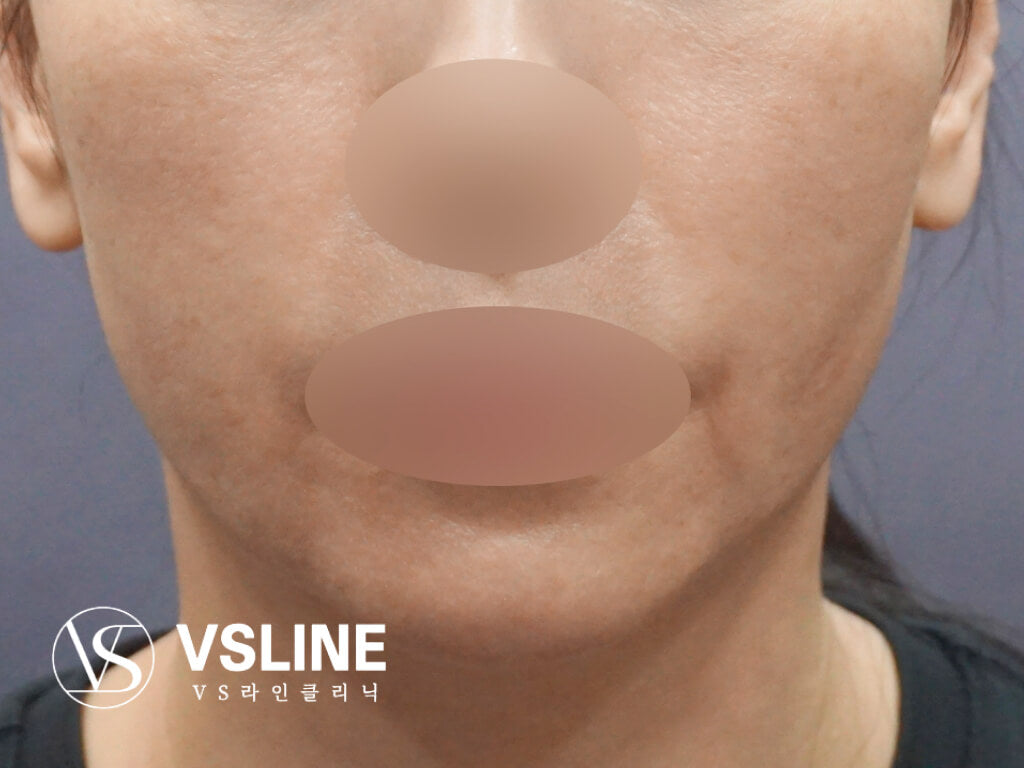 image comparison after