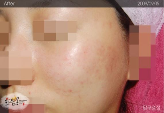 image comparison after