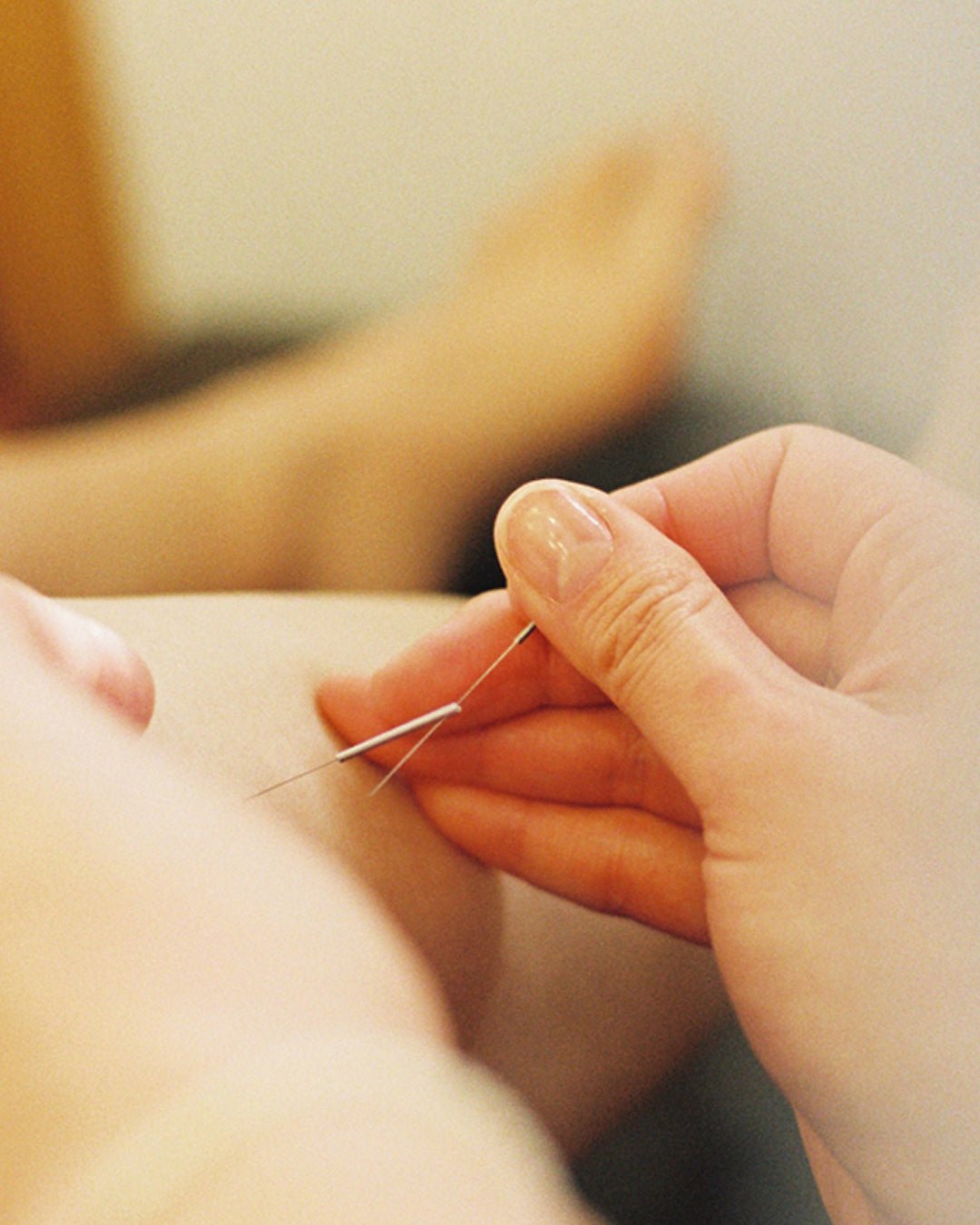 A Tong-in clinic doctor performing acupuncture on the patient's leg.